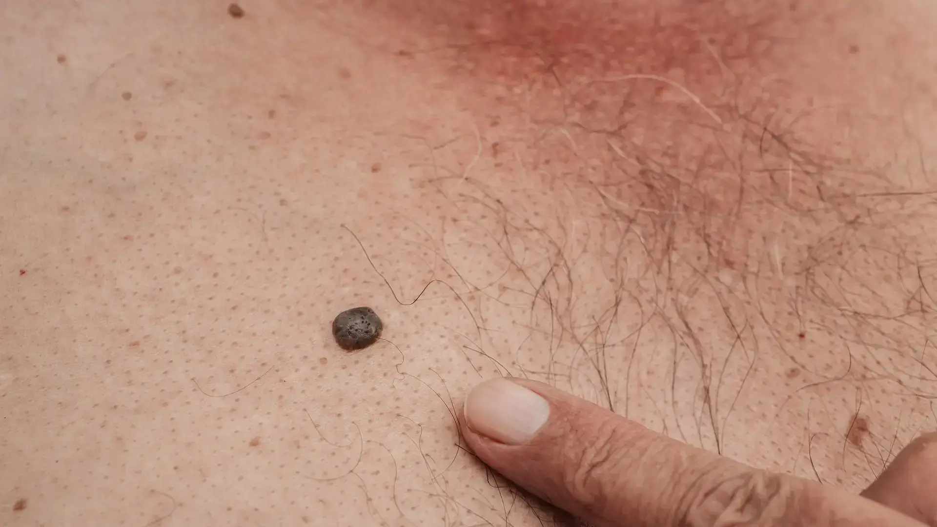 Squamous Cell Skin Cancer